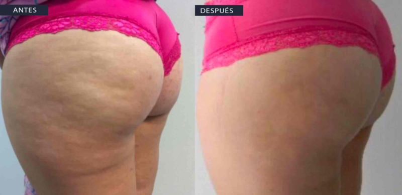 gluteos enzimas