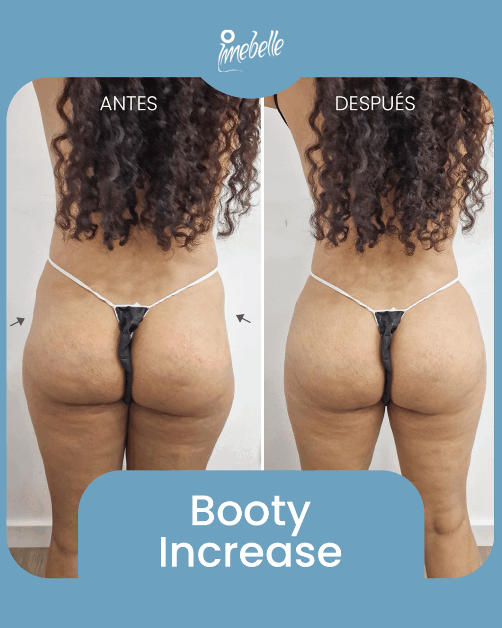 Aumento de glúteos con resultado inmediato